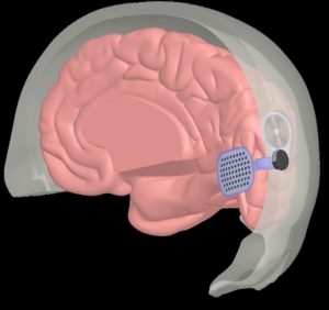 Second Sight Orion I Brain Implant